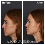 4 Rhinoplasty Before And After 20