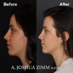 4 Rhinoplasty Before And After 21