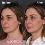 4 Rhinoplasty Before And After 22