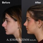 4 Rhinoplasty Before And After 25