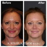 4 Rhinoplasty Before And After 27