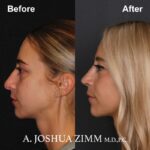 4 Rhinoplasty Before And After 28