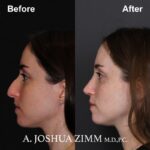 4 Rhinoplasty Before And After 29