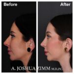 4 Rhinoplasty Before And After 30