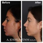 4 Rhinoplasty Before And After 33