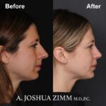 4 Rhinoplasty Before And After 36