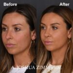 4 Rhinoplasty Before And After 38