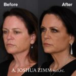 4 Rhinoplasty Before And After 4