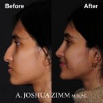 4 Rhinoplasty Before And After 40