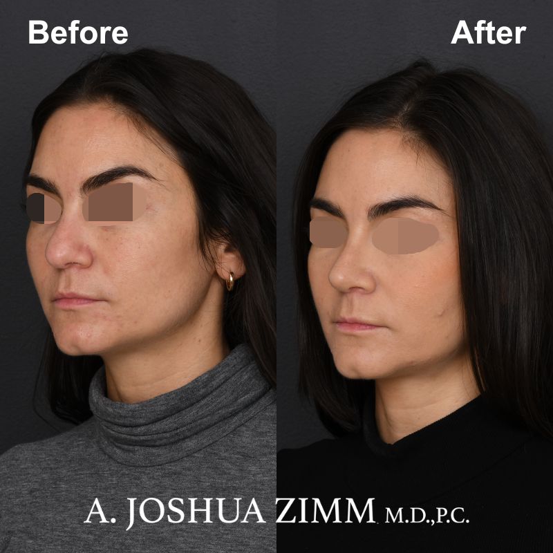 4 Rhinoplasty Before And After 43