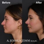 4 Rhinoplasty Before And After 44