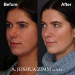 4 Rhinoplasty Before And After 46