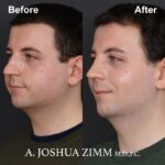 4 Rhinoplasty Before And After 47