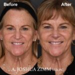 4 Rhinoplasty Before And After 48