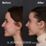 4 Rhinoplasty Before And After 49