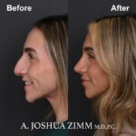 4 Rhinoplasty Before And After 5