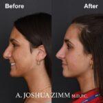 4 Rhinoplasty Before And After 51