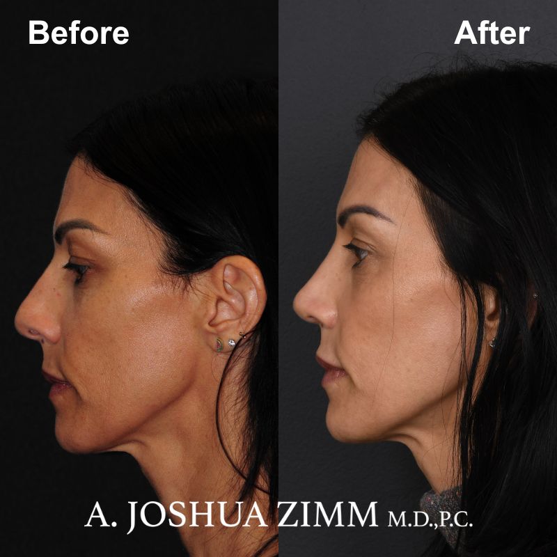 4 Rhinoplasty Before And After 52