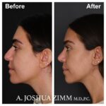 4 Rhinoplasty Before And After 53