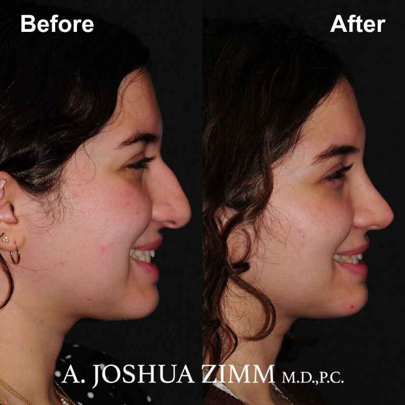 4 Rhinoplasty Before And After 54