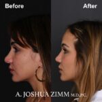 4 Rhinoplasty Before And After 55