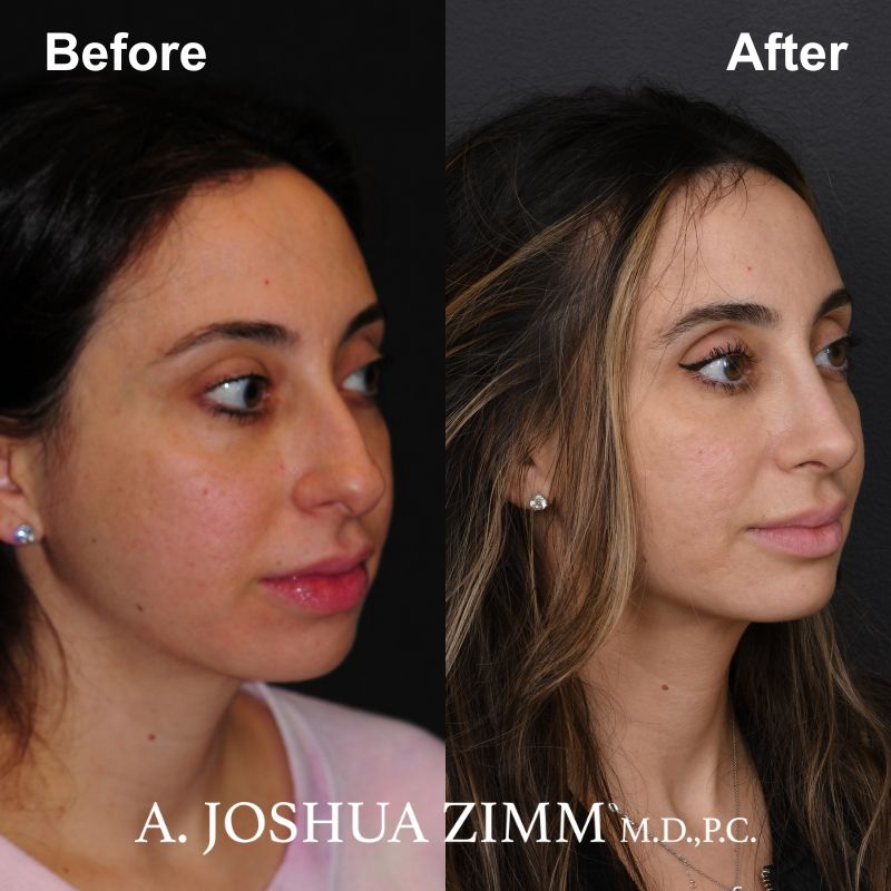 4 Rhinoplasty Before And After 56
