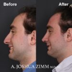 4 Rhinoplasty Before And After 57