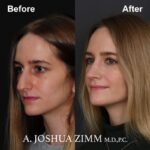 4 Rhinoplasty Before And After 58