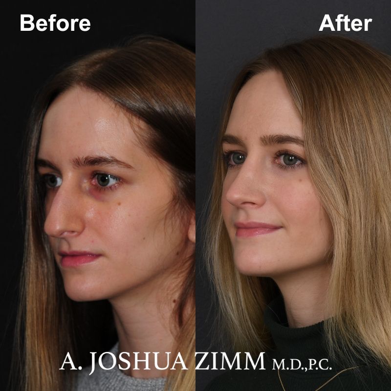 4 Rhinoplasty Before And After 58