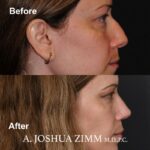 4 Rhinoplasty Before And After 59