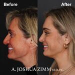 4 Rhinoplasty Before And After 60