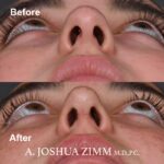 4 Rhinoplasty Before And After 61