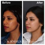 4 Rhinoplasty Before And After 62