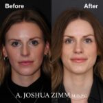 4 Rhinoplasty Before And After 8