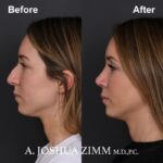 4 Rhinoplasty Before And After 9