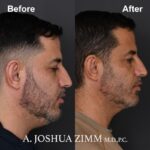 4.FaceTite AccuTite Before And After