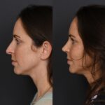 4mo LPNS