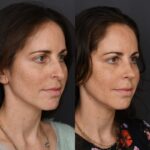 4mo R3.4V