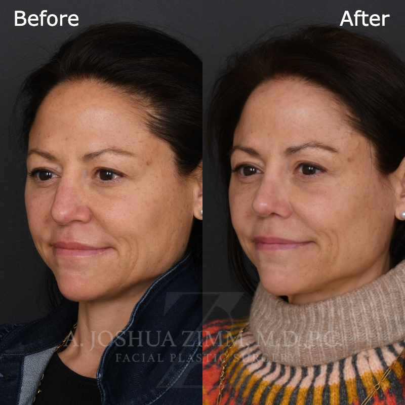 5 3 Mo Post Revision L3.4V
