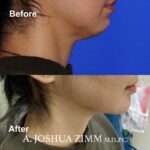 5 FaceTite AccuTite Before And Afte