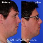 5 FaceTite AccuTite Before And After 1