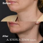 5 FaceTite AccuTite Before And After