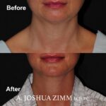 5 FaceTite AccuTite Before And After 2