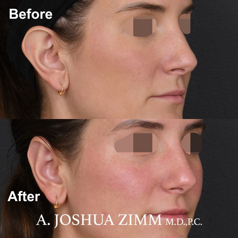 5 Otoplasty Before And After