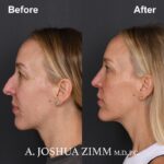 5 Chin Implant Before And After 1