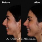 5 Chin Implant Before And After 1 2