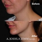5 Chin Implant Before And After