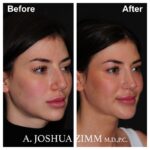 5 Chin Implant Before And After 2