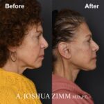 5 Facelift Before And After 2