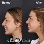 5 Revision Rhinoplasty 1